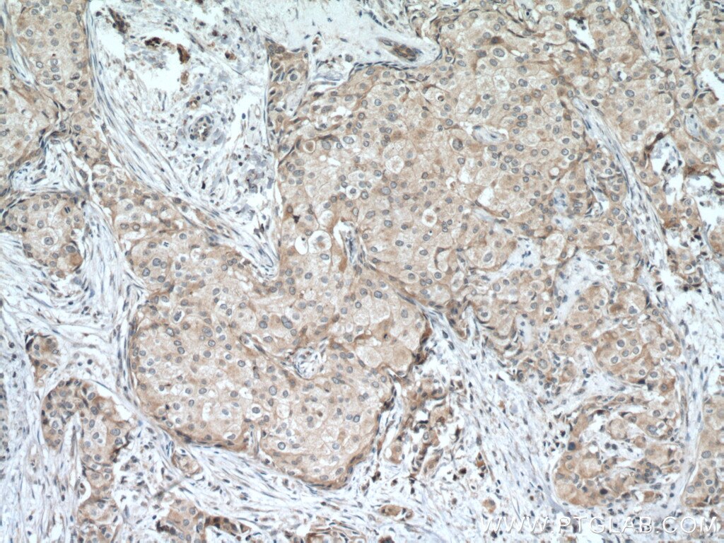 Immunohistochemistry (IHC) staining of human breast cancer tissue using CST6 Polyclonal antibody (17076-1-AP)