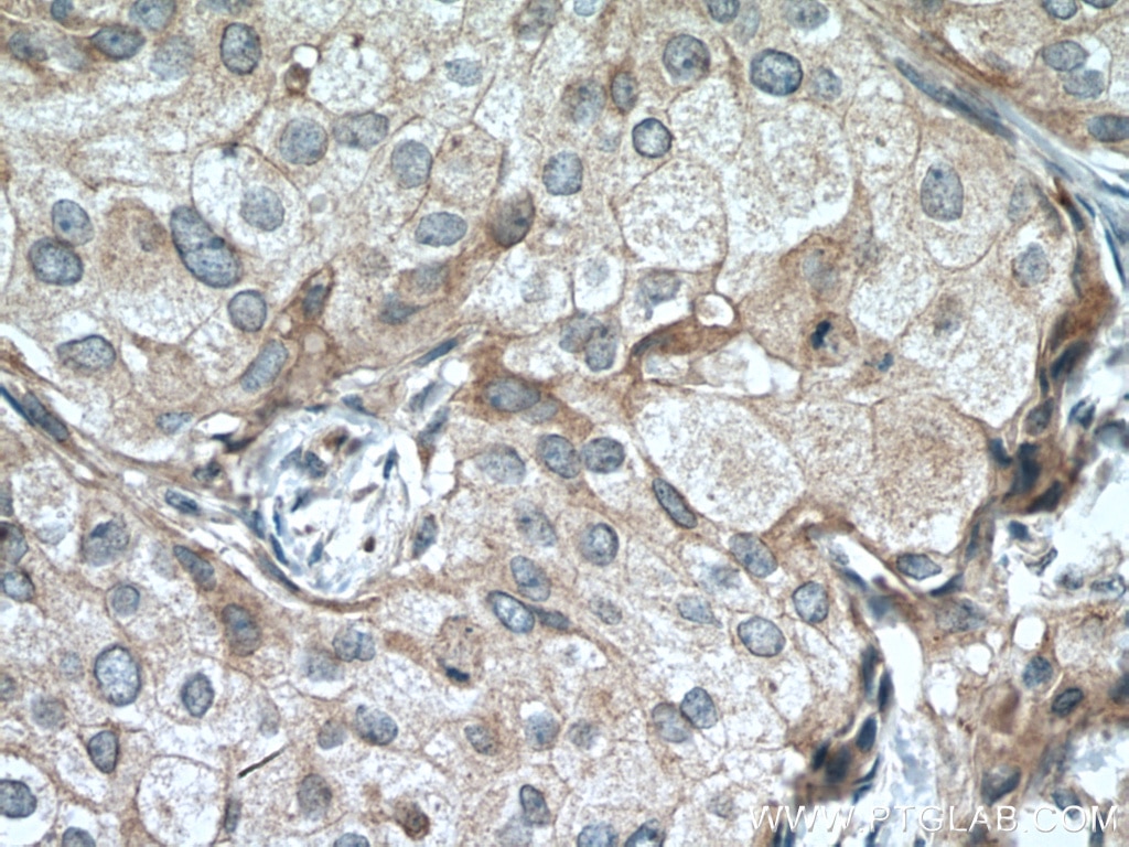 Immunohistochemistry (IHC) staining of human breast cancer tissue using CST6 Polyclonal antibody (17076-1-AP)