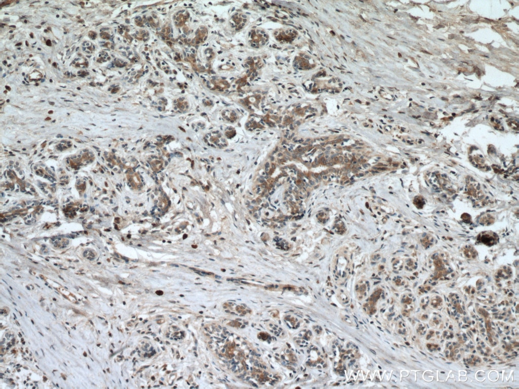 Immunohistochemistry (IHC) staining of human breast cancer tissue using CST6 Polyclonal antibody (17076-1-AP)