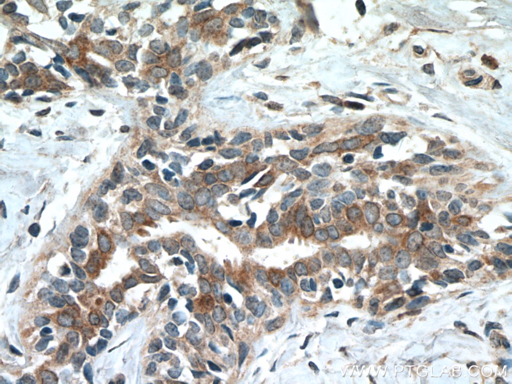 Immunohistochemistry (IHC) staining of human breast cancer tissue using CST6 Polyclonal antibody (17076-1-AP)