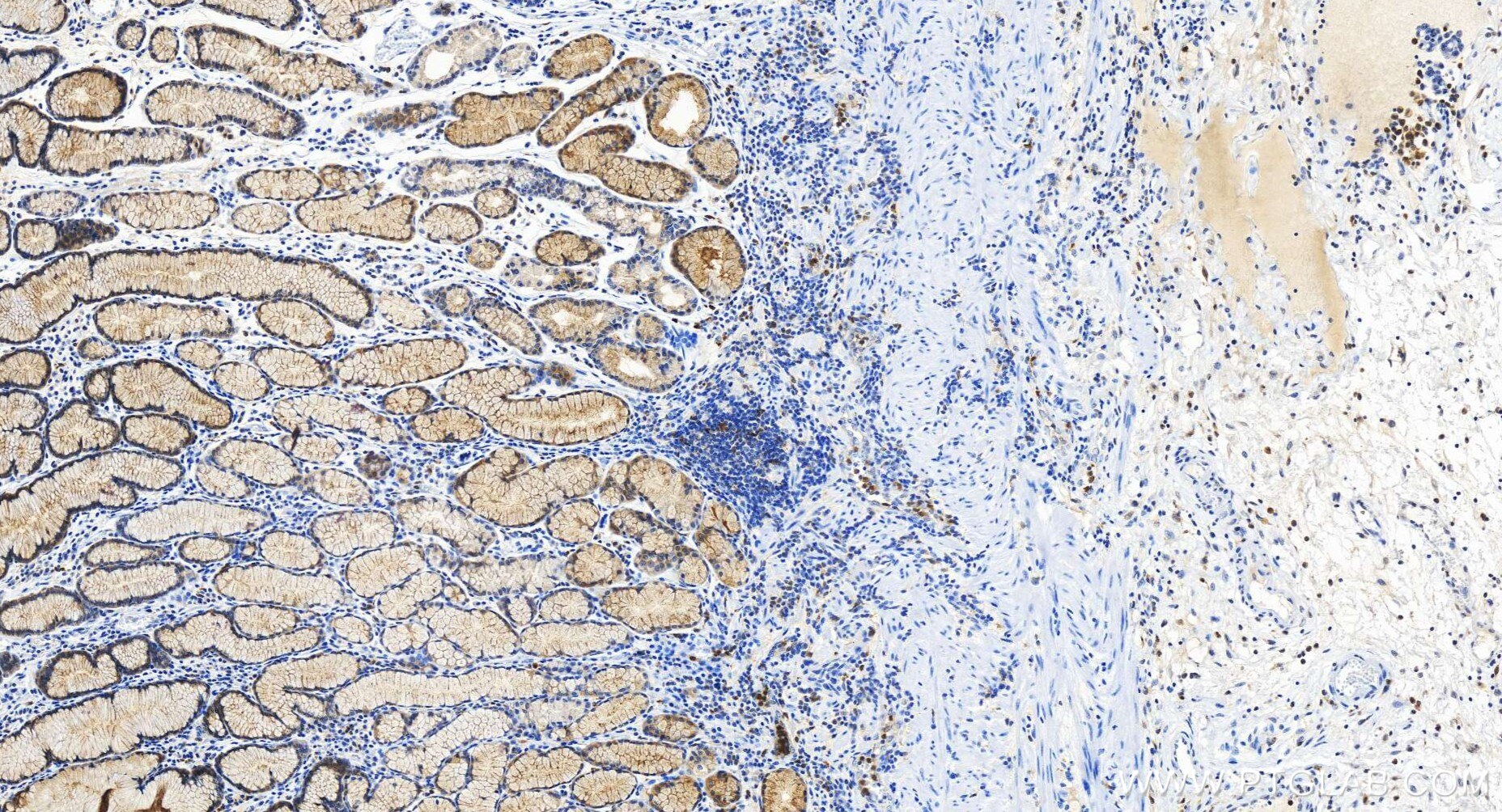 Immunohistochemical analysis of paraffin-embedded human stomach cancer tissue slide using 84953-4-RR (Cystatin A antibody) at dilution of 1:500 (under 20x lens). Heat mediated antigen retrieval with Tris-EDTA buffer (pH 9.0). Immunohistochemistry (IHC) staining of human stomach cancer tissue using Cystatin A Recombinant monoclonal antibody (84953-4-RR)