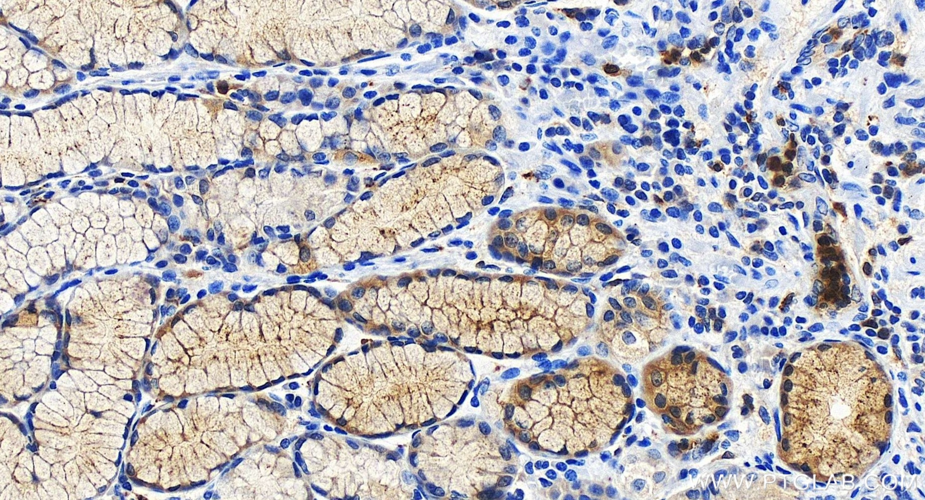 Immunohistochemical analysis of paraffin-embedded human stomach cancer tissue slide using 84953-4-RR (Cystatin A antibody) at dilution of 1:500 (under 20x lens). Heat mediated antigen retrieval with Tris-EDTA buffer (pH 9.0). Immunohistochemistry (IHC) staining of human stomach cancer tissue using Cystatin A Recombinant monoclonal antibody (84953-4-RR)