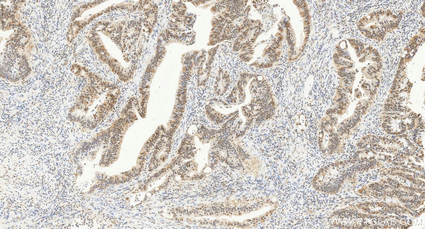 Immunohistochemistry (IHC) staining of human colon cancer tissue using CSTF2T Polyclonal antibody (14206-1-AP)