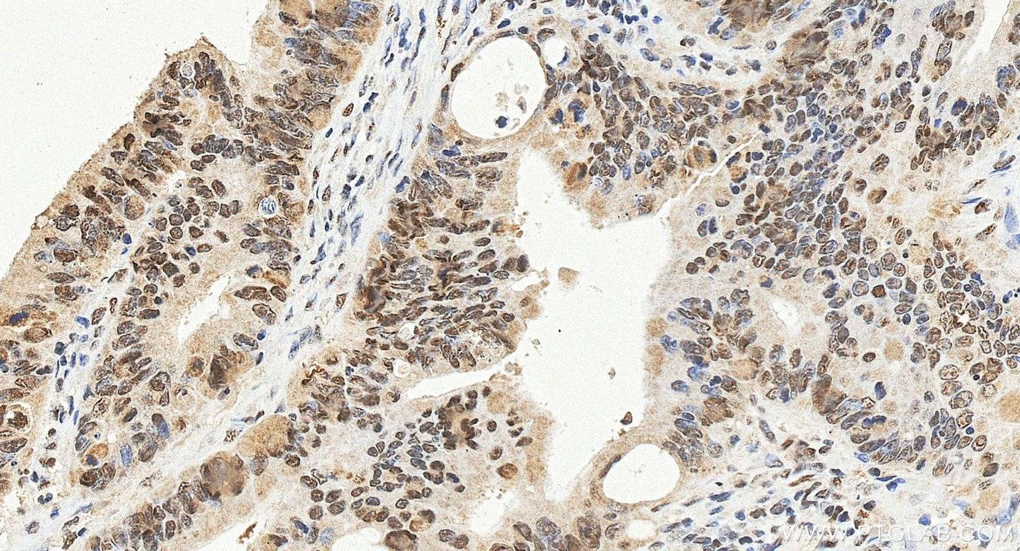 Immunohistochemistry (IHC) staining of human colon cancer tissue using CSTF2T Polyclonal antibody (14206-1-AP)