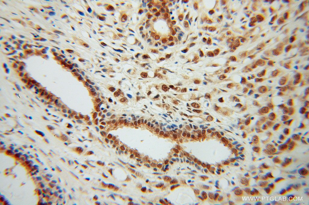 Immunohistochemistry (IHC) staining of human prostate cancer tissue using CSTF2T Polyclonal antibody (14206-1-AP)