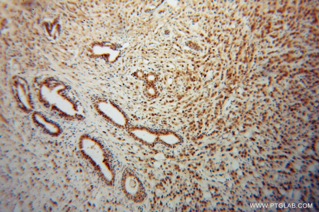 Immunohistochemistry (IHC) staining of human prostate cancer tissue using CSTF2T Polyclonal antibody (14206-1-AP)