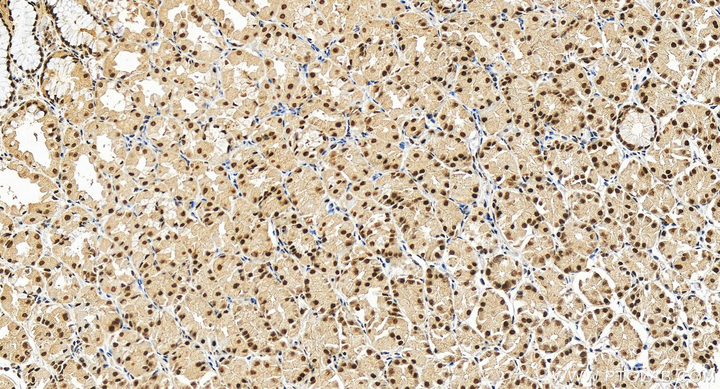 Immunohistochemistry (IHC) staining of human stomach cancer tissue using CSTF3 Polyclonal antibody (24290-1-AP)