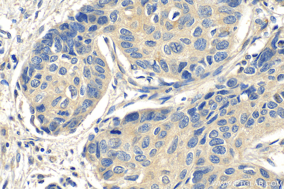 Immunohistochemistry (IHC) staining of human lung cancer tissue using NY-ESO-1 Polyclonal antibody (19521-1-AP)