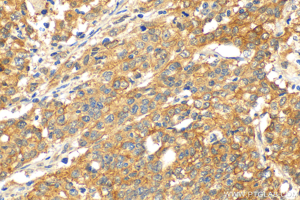 Immunohistochemistry (IHC) staining of human stomach cancer tissue using NY-ESO-1 Polyclonal antibody (19521-1-AP)