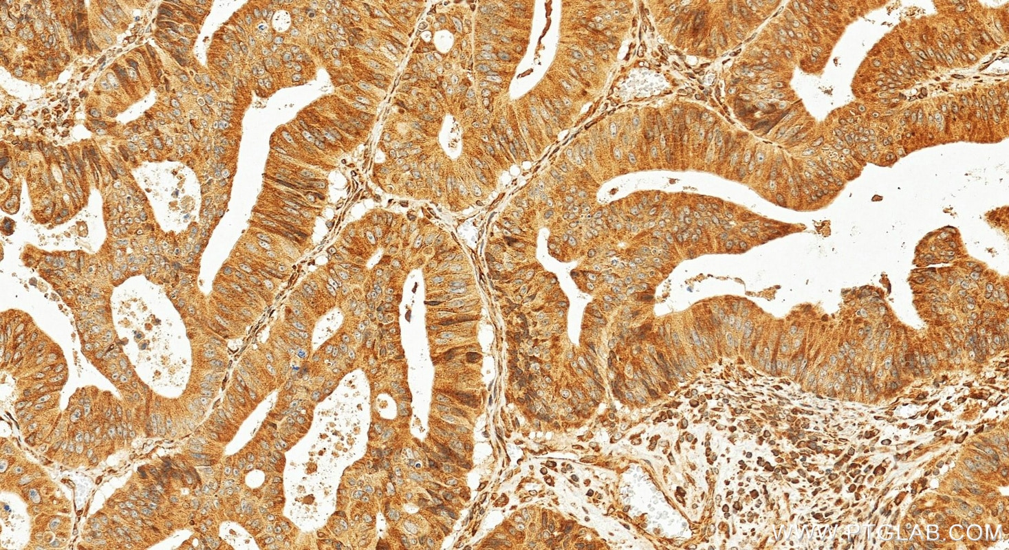 Immunohistochemistry (IHC) staining of human colon cancer tissue using CTAGE5 Polyclonal antibody (55279-1-AP)