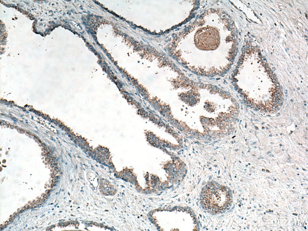 Immunohistochemistry (IHC) staining of human prostate cancer tissue using CTAGE5 Polyclonal antibody (55279-1-AP)