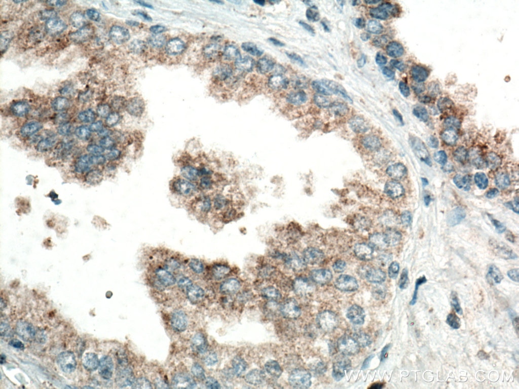 Immunohistochemistry (IHC) staining of human prostate cancer tissue using CTAGE5 Polyclonal antibody (55279-1-AP)