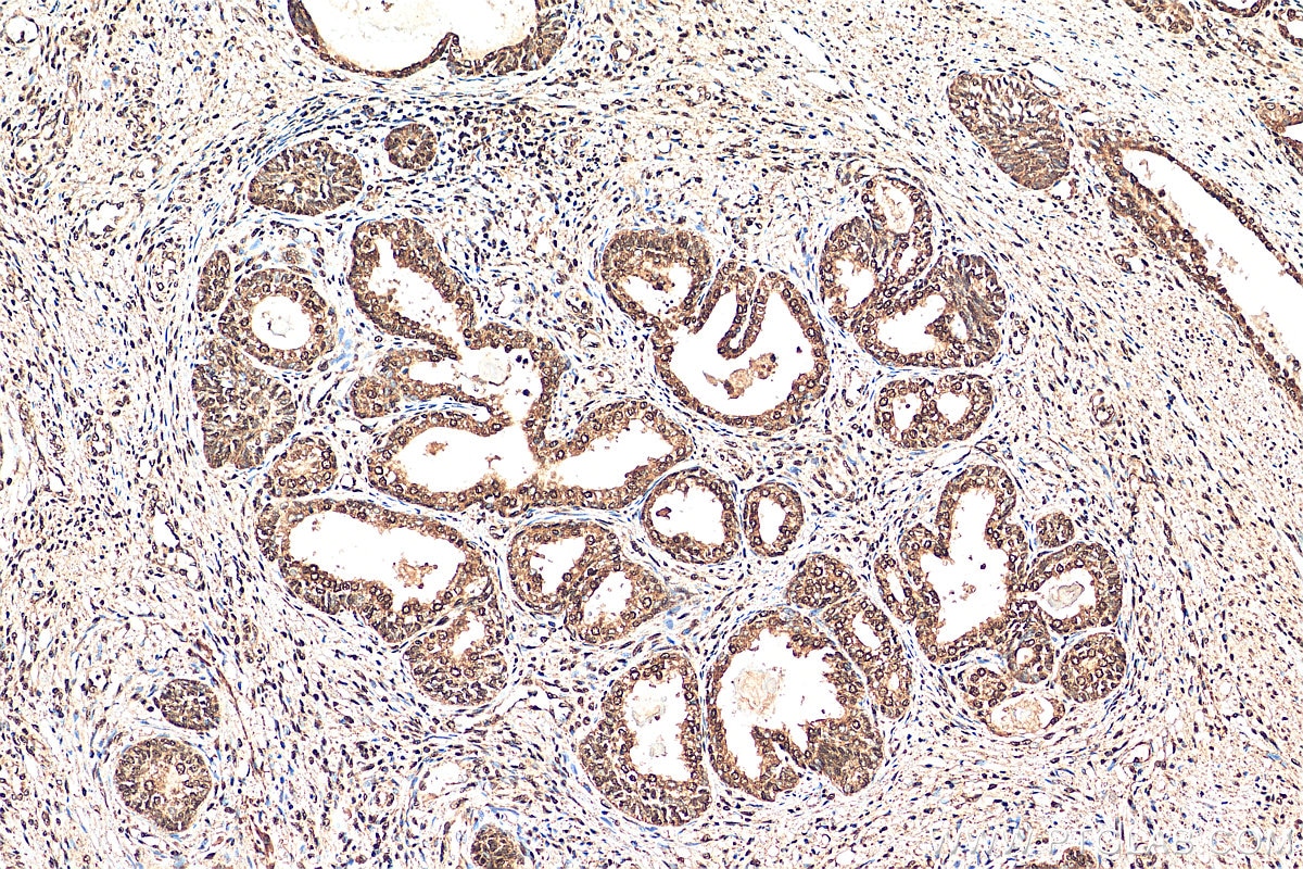 Immunohistochemistry (IHC) staining of human prostate cancer tissue using CTBP1 Polyclonal antibody (10972-1-AP)