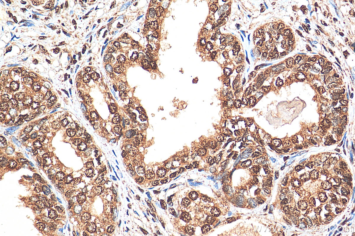 Immunohistochemistry (IHC) staining of human prostate cancer tissue using CTBP1 Polyclonal antibody (10972-1-AP)