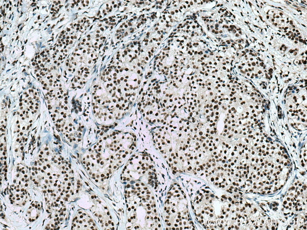 Immunohistochemistry (IHC) staining of human breast cancer tissue using CTBP1 Monoclonal antibody (66995-1-Ig)