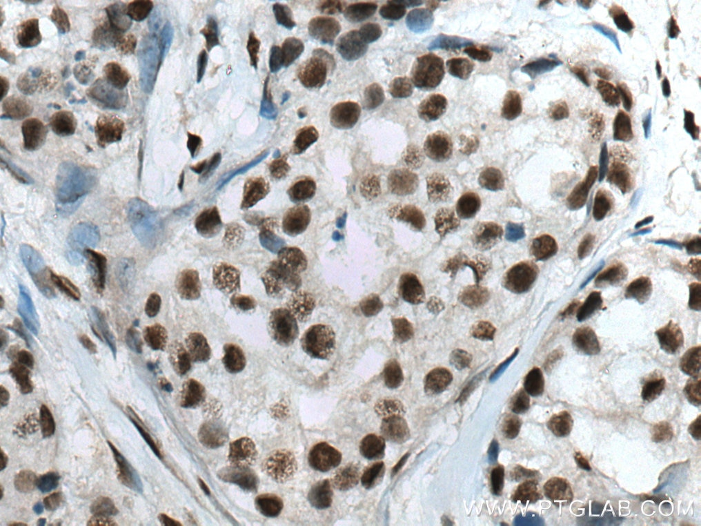 Immunohistochemistry (IHC) staining of human breast cancer tissue using CTBP1 Monoclonal antibody (66995-1-Ig)