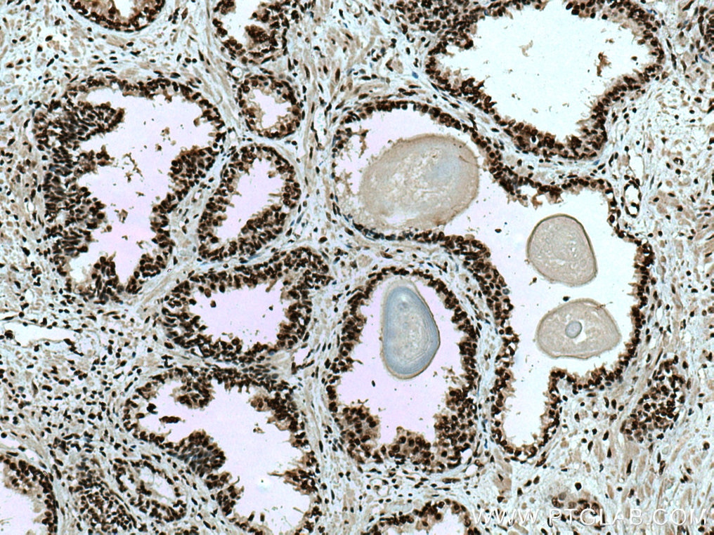 Immunohistochemistry (IHC) staining of human prostate cancer tissue using CTBP1 Monoclonal antibody (66995-1-Ig)