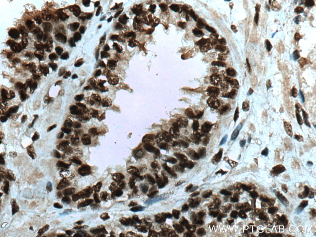 IHC staining of human prostate cancer using 66995-1-Ig