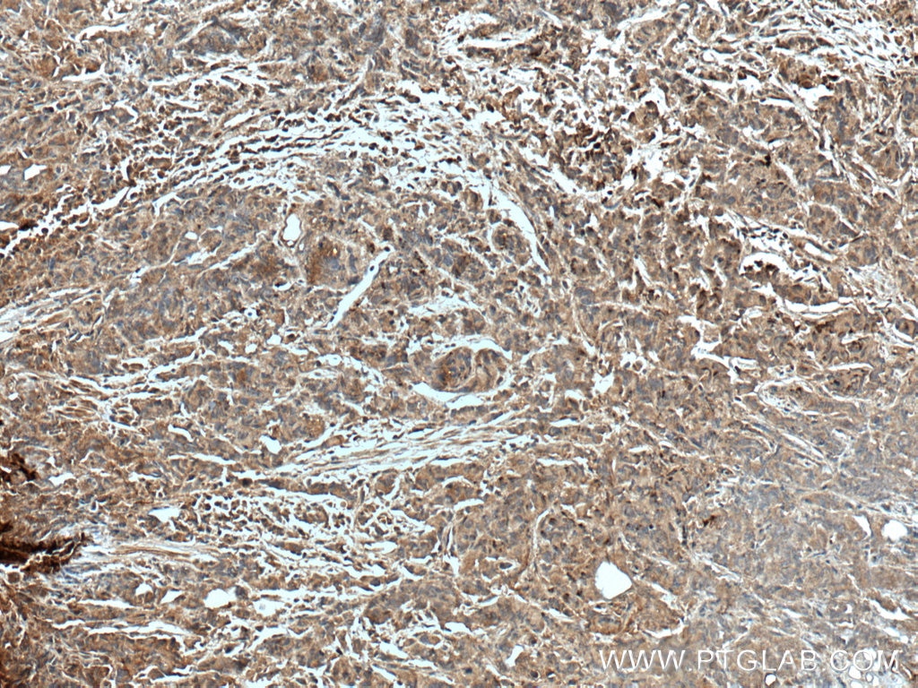 Immunohistochemistry (IHC) staining of human prostate cancer tissue using CTBS Polyclonal antibody (12599-1-AP)