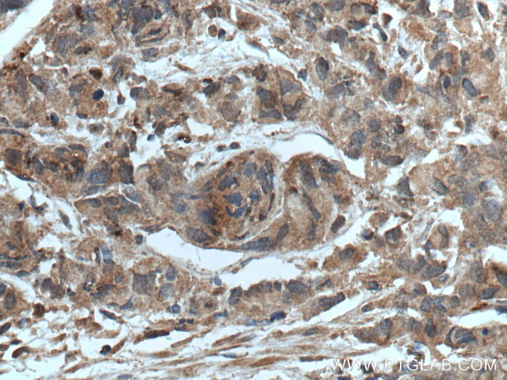 Immunohistochemistry (IHC) staining of human prostate cancer tissue using CTBS Polyclonal antibody (12599-1-AP)