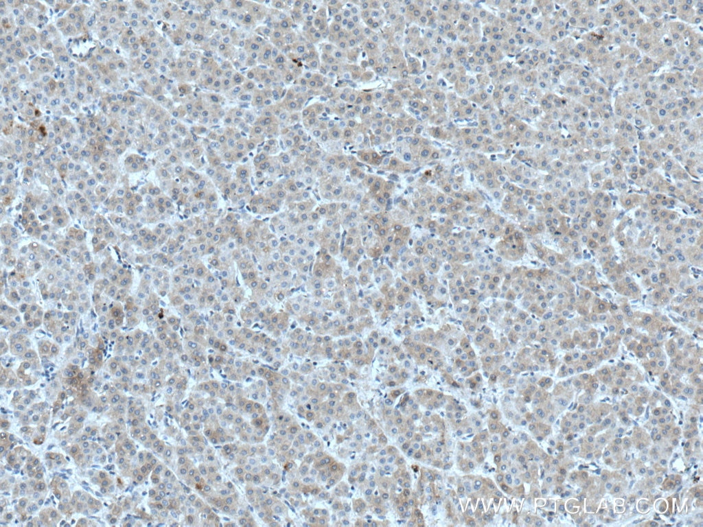 Immunohistochemistry (IHC) staining of human liver cancer tissue using CTBS Polyclonal antibody (12599-1-AP)