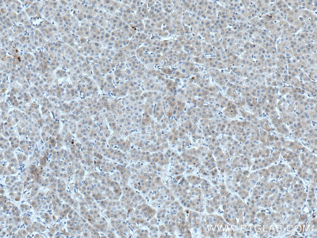 IHC staining of human liver cancer using 12599-1-AP