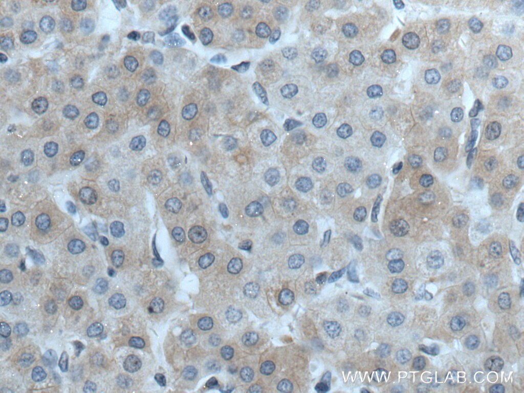 Immunohistochemistry (IHC) staining of human liver cancer tissue using CTBS Polyclonal antibody (12599-1-AP)