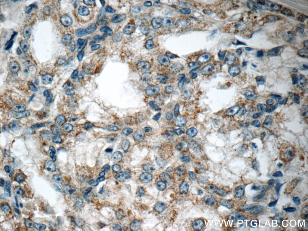 Immunohistochemistry (IHC) staining of human prostate cancer tissue using CTBS Polyclonal antibody (12599-1-AP)