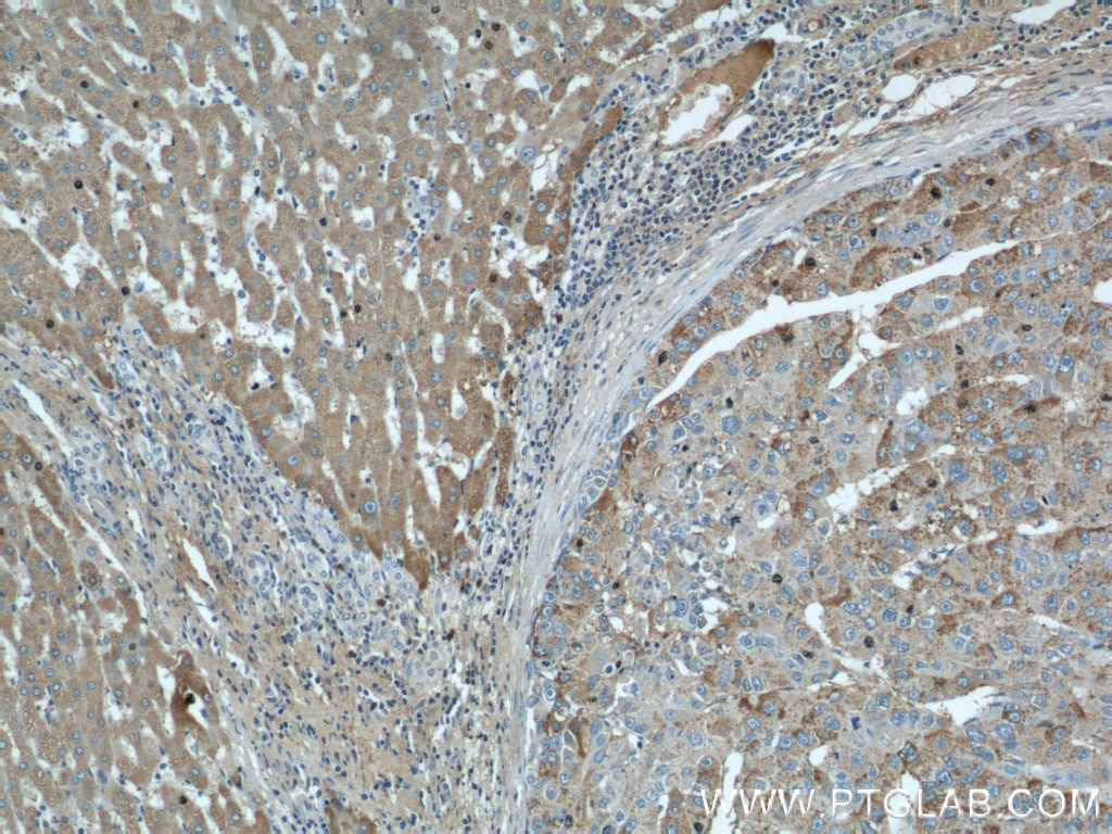 Immunohistochemistry (IHC) staining of human liver cancer tissue using CTBS Polyclonal antibody (12599-1-AP)