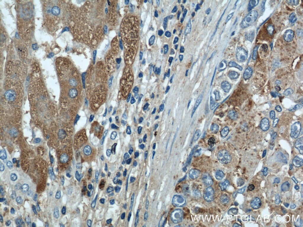 Immunohistochemistry (IHC) staining of human liver cancer tissue using CTBS Polyclonal antibody (12599-1-AP)