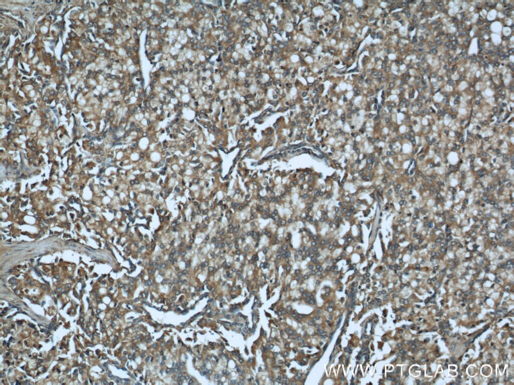 IHC staining of human prostate cancer using 12599-1-AP