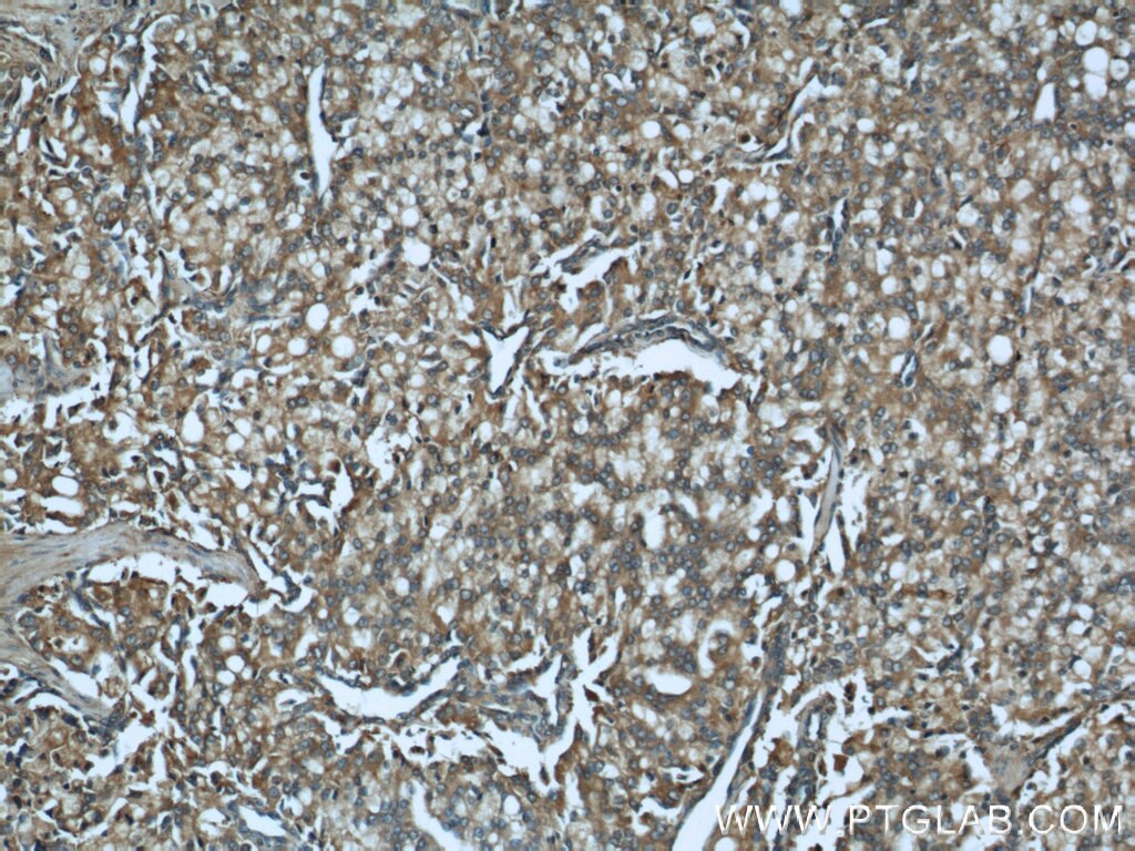 Immunohistochemistry (IHC) staining of human prostate cancer tissue using CTBS Polyclonal antibody (12599-1-AP)