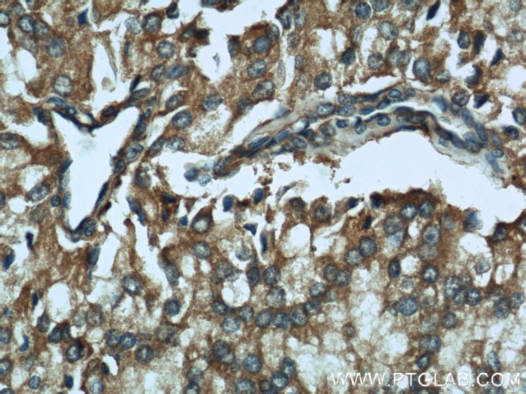 Immunohistochemistry (IHC) staining of human prostate cancer tissue using CTBS Polyclonal antibody (12599-1-AP)