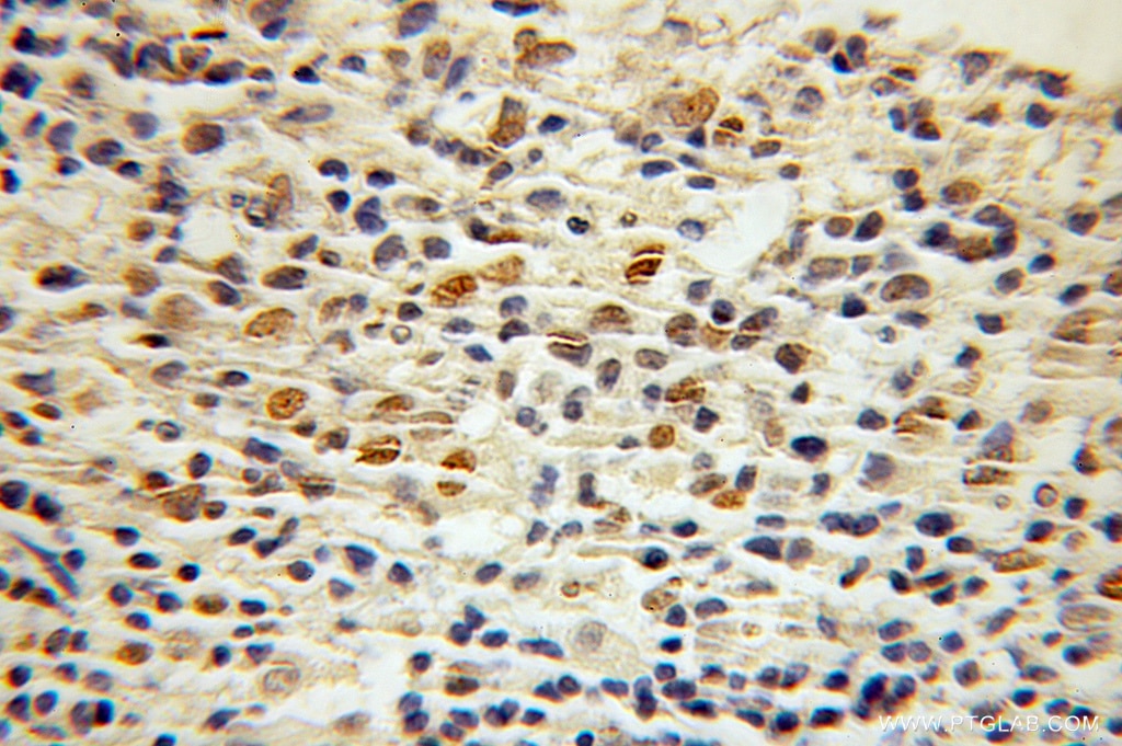 Immunohistochemistry (IHC) staining of human lymphoma tissue using CTCF Polyclonal antibody (10915-1-AP)