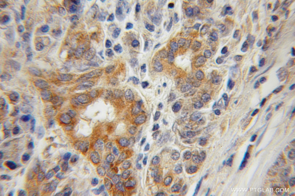 Immunohistochemistry (IHC) staining of human pancreas cancer tissue using CTDSP2 Polyclonal antibody (11116-1-AP)