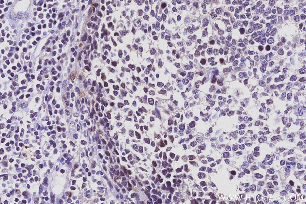 Immunohistochemistry (IHC) staining of human tonsillitis tissue using CTDSPL2 Polyclonal antibody (17532-1-AP)