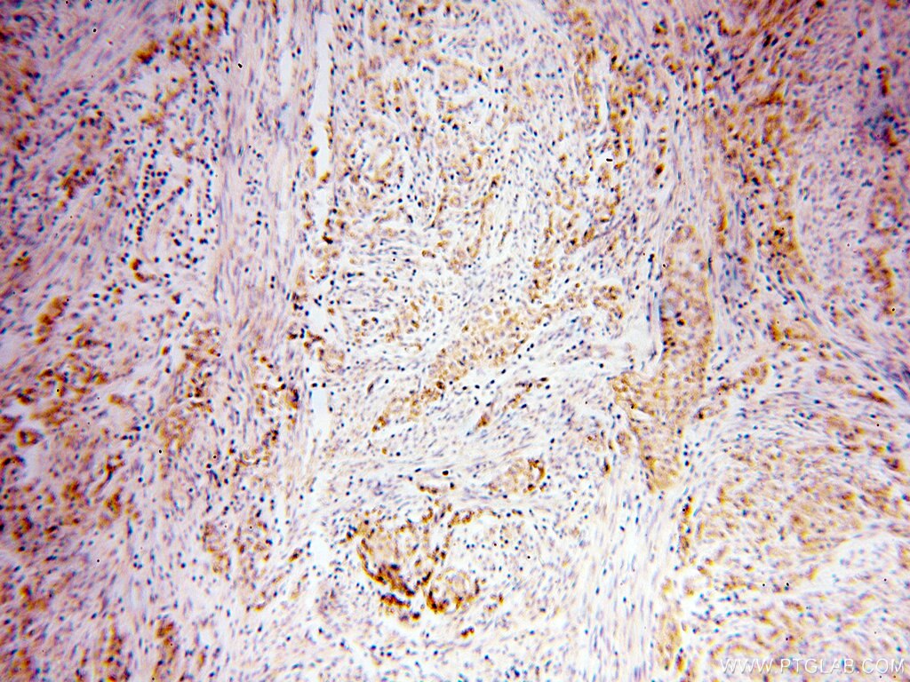 Immunohistochemistry (IHC) staining of human endometrial cancer tissue using CTDSPL2 Polyclonal antibody (17532-1-AP)