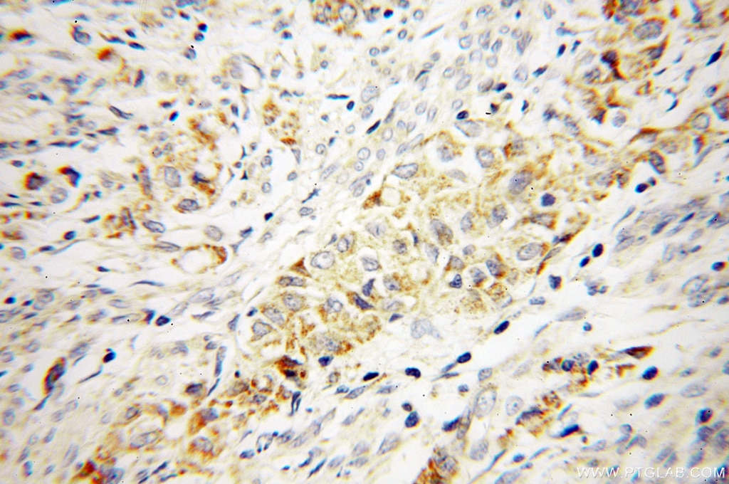 Immunohistochemistry (IHC) staining of human endometrial cancer tissue using CTDSPL2 Polyclonal antibody (17532-1-AP)