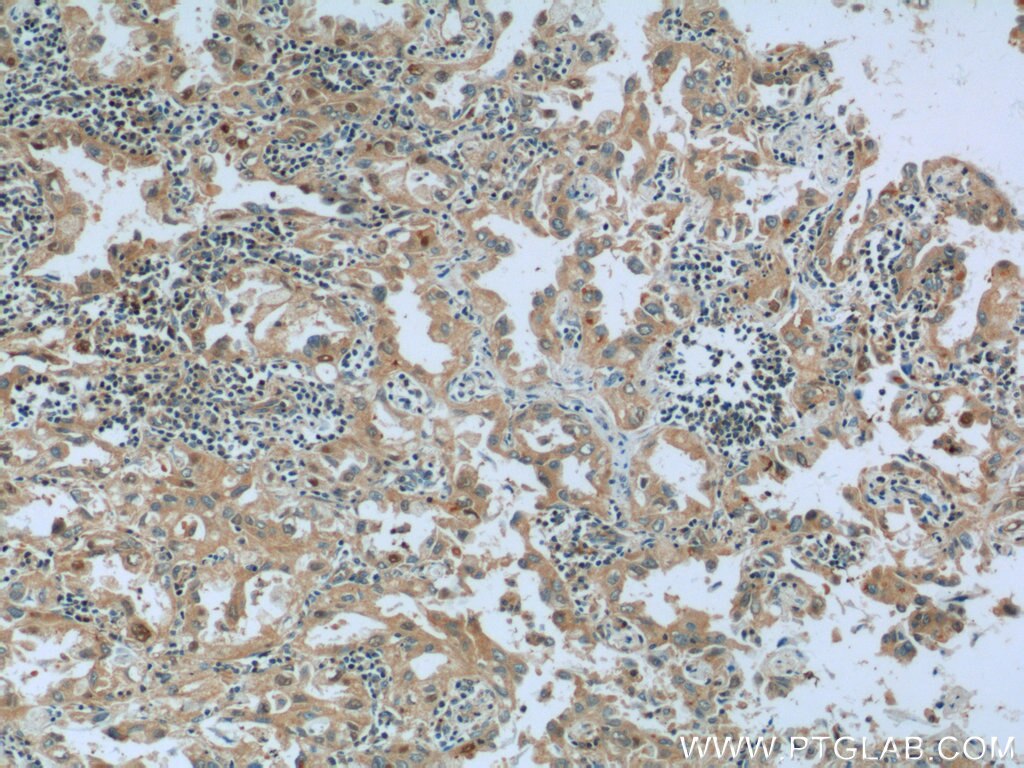 IHC staining of human lung cancer using 17518-1-AP
