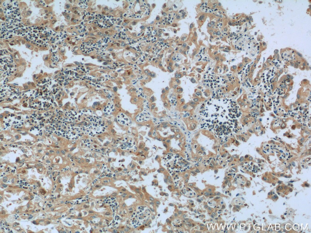 Immunohistochemistry (IHC) staining of human lung cancer tissue using CTF1-Specific Polyclonal antibody (17518-1-AP)