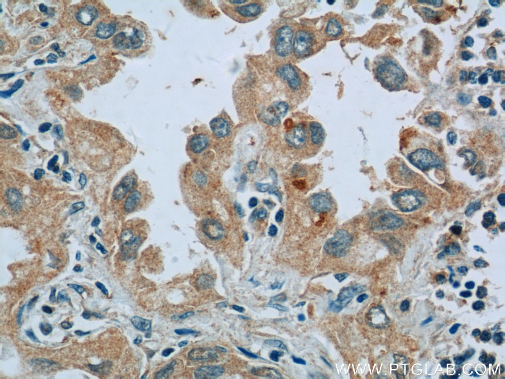 Immunohistochemistry (IHC) staining of human lung cancer tissue using CTF1-Specific Polyclonal antibody (17518-1-AP)