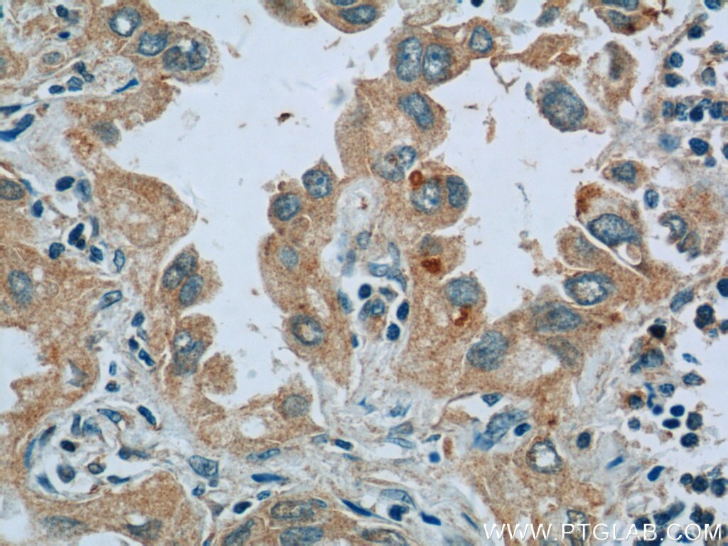 IHC staining of human lung cancer using 17518-1-AP