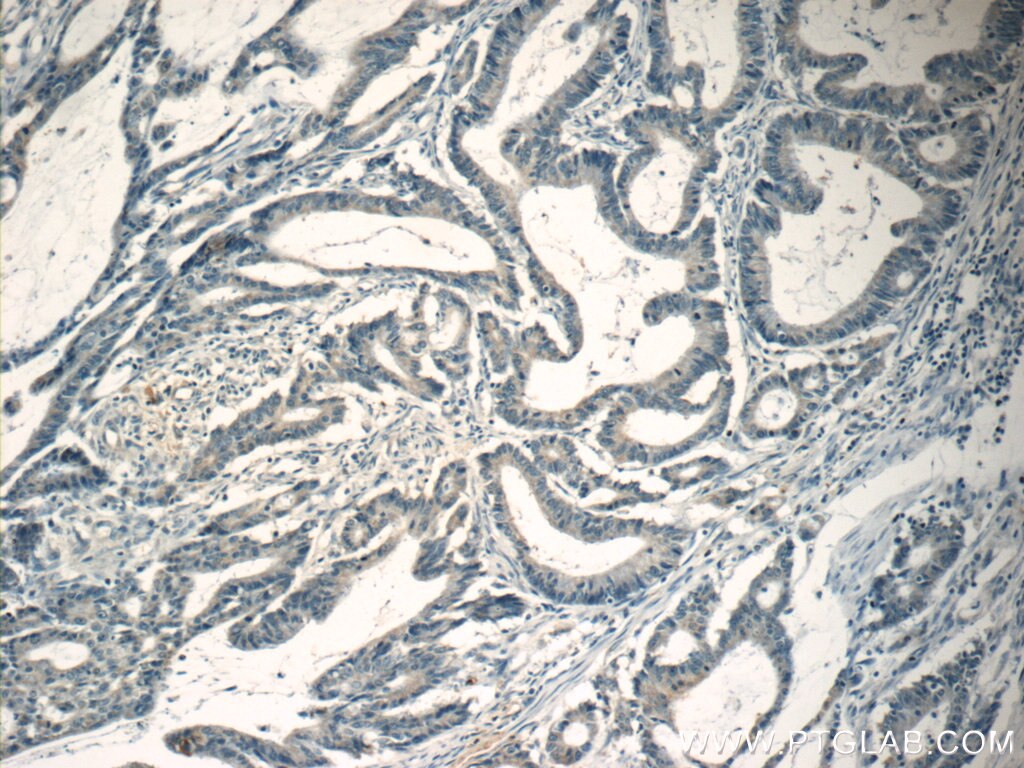 Immunohistochemistry (IHC) staining of human colon cancer tissue using CTGF Polyclonal antibody (23903-1-AP)