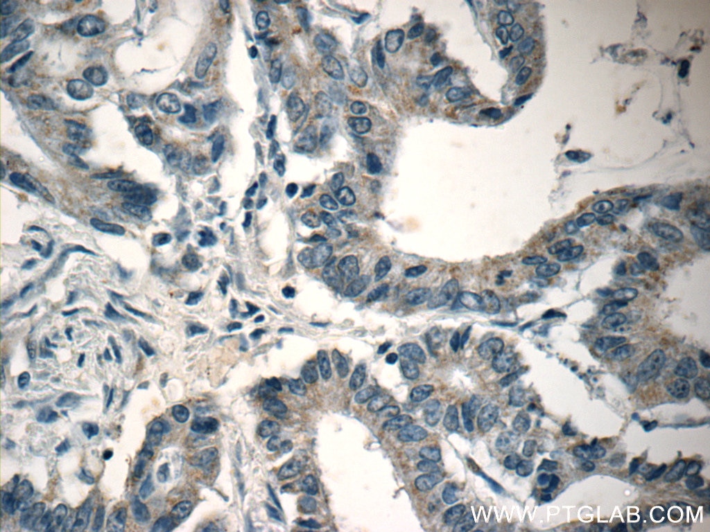 Immunohistochemistry (IHC) staining of human colon cancer tissue using CTGF Polyclonal antibody (23903-1-AP)