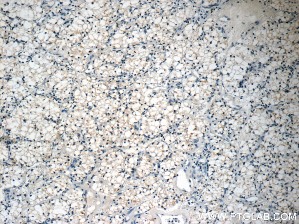 Immunohistochemistry (IHC) staining of human nephroblastoma tissue using CTGF Polyclonal antibody (23903-1-AP)