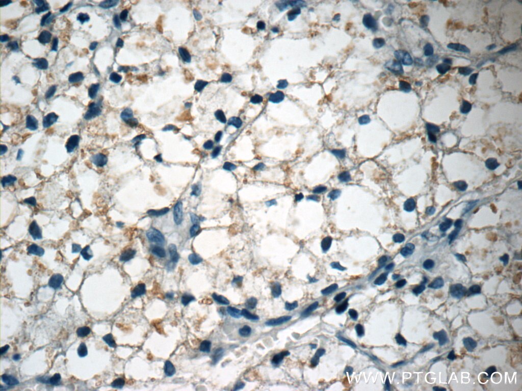 Immunohistochemistry (IHC) staining of human nephroblastoma tissue using CTGF Polyclonal antibody (23903-1-AP)