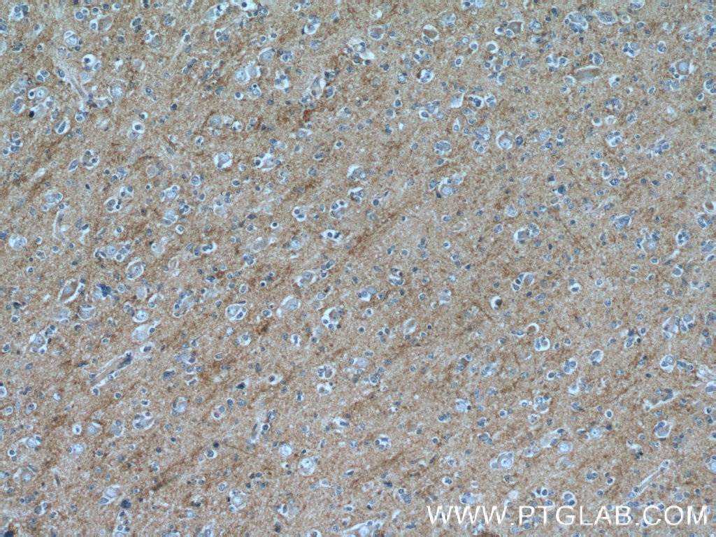 Immunohistochemistry (IHC) staining of human gliomas tissue using CTGF Polyclonal antibody (23936-1-AP)