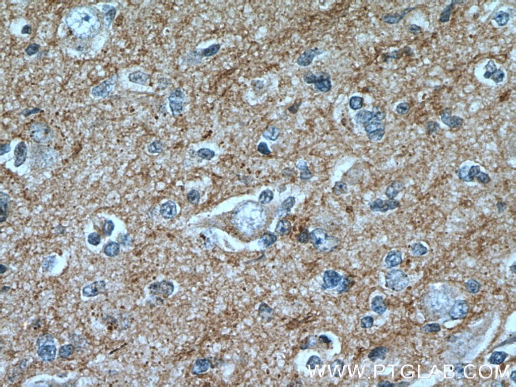 Immunohistochemistry (IHC) staining of human gliomas tissue using CTGF Polyclonal antibody (23936-1-AP)