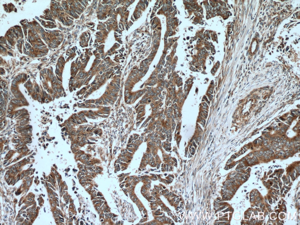 Immunohistochemistry (IHC) staining of human colon cancer tissue using CTGF Polyclonal antibody (23936-1-AP)