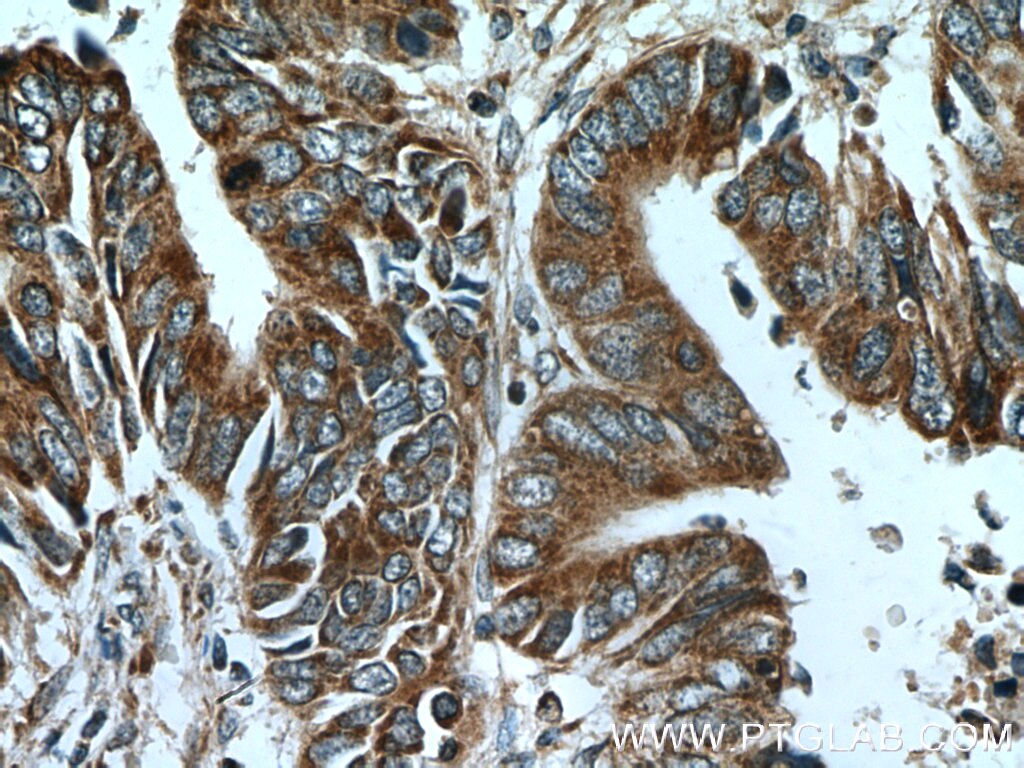 IHC staining of human colon cancer using 23936-1-AP